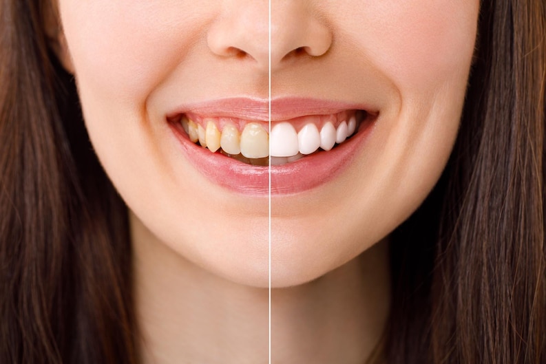 Teeth-Whitening-Benefits